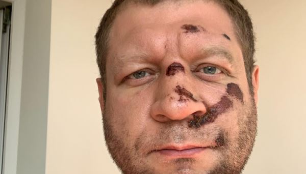 Александр Емельяненко разбил лицо, и не выступит в мае